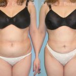 Abdominoplasty Before and After Photos in Montvale, NJ, Patient 12226