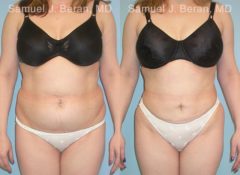 Abdominoplasty Before and After Photos in Montvale, NJ, Patient 12226