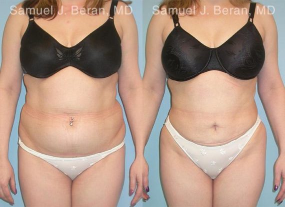 Abdominoplasty Before and After Photos in Montvale, NJ, Patient 12226