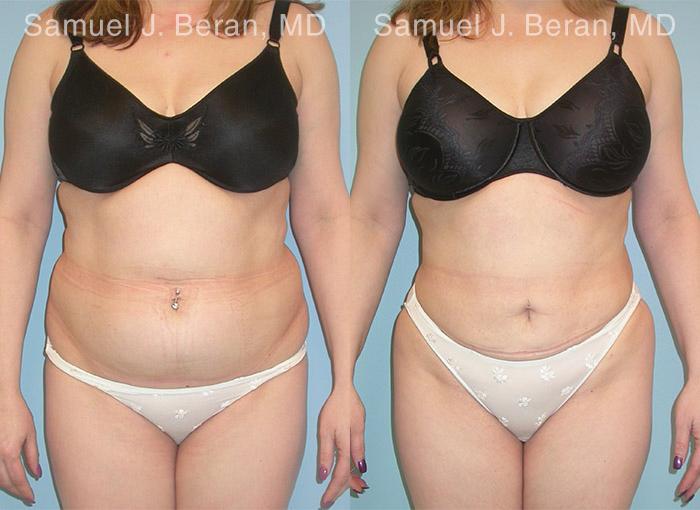 Abdominoplasty Before and After Photos in Montvale, NJ, Patient 12226