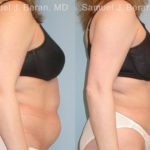 Abdominoplasty Before and After Photos in Montvale, NJ, Patient 12226