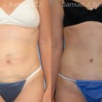 Abdominoplasty Before and After Photos in Montvale, NJ, Patient 12239
