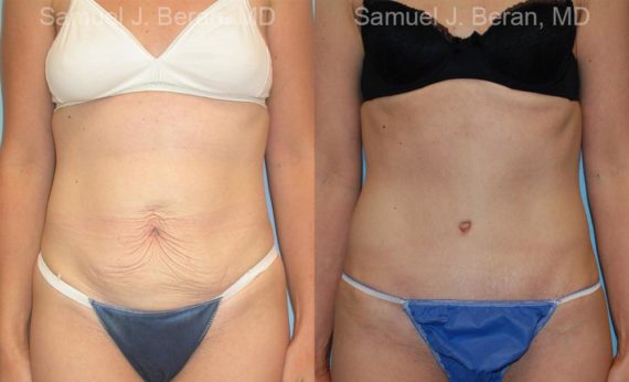 Abdominoplasty Before and After Photos in Montvale, NJ, Patient 12239