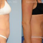 Abdominoplasty Before and After Photos in Montvale, NJ, Patient 12239