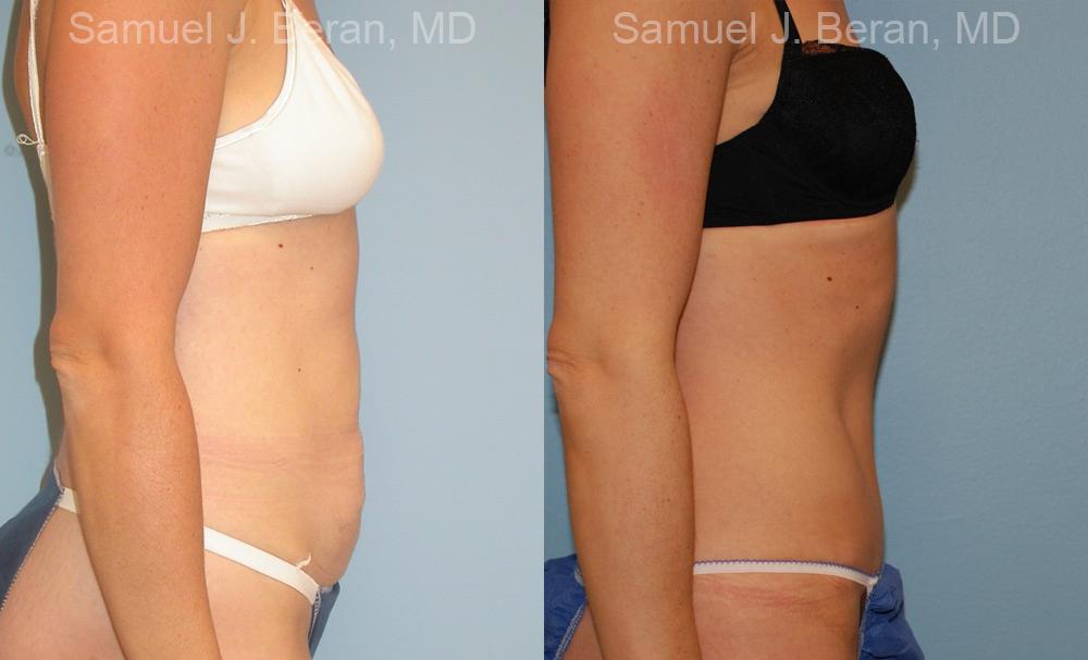 Abdominoplasty Before and After Photos in Montvale, NJ, Patient 12239