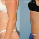 Abdominoplasty Before and After Photos in Montvale, NJ, Patient 12239