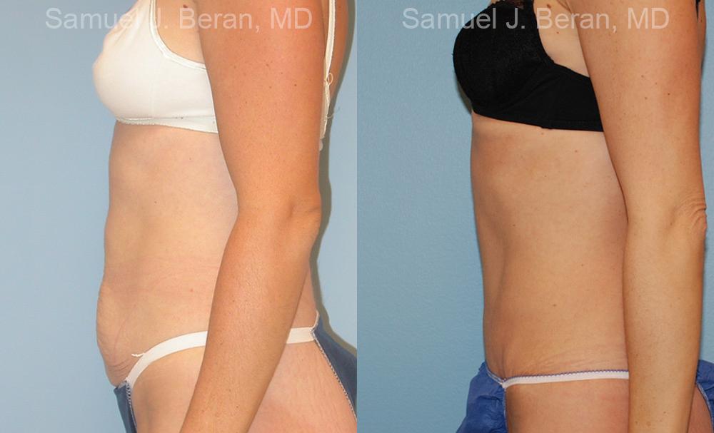 Abdominoplasty Before and After Photos in Montvale, NJ, Patient 12239