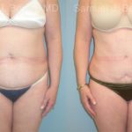 Abdominoplasty Before and After Photos in Montvale, NJ, Patient 12258