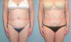Abdominoplasty Before and After Photos in Montvale, NJ, Patient 12258