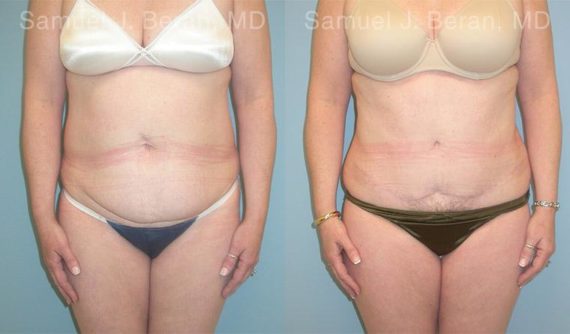 Abdominoplasty Before and After Photos in Montvale, NJ, Patient 12258