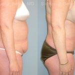 Abdominoplasty Before and After Photos in Montvale, NJ, Patient 12258