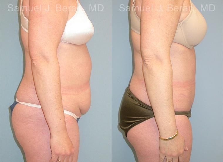 Abdominoplasty Before and After Photos in Montvale, NJ, Patient 12258