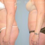 Abdominoplasty Before and After Photos in Montvale, NJ, Patient 12258