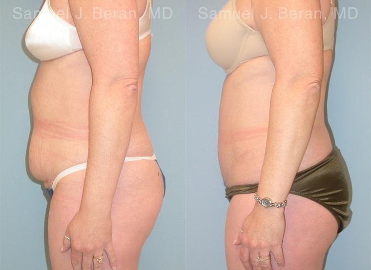 Abdominoplasty Before and After Photos in Montvale, NJ, Patient 12258