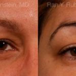 Botox Before and After Photos in Montvale, NJ, Patient 12268