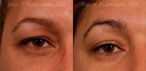 Botox Before and After Photos in Montvale, NJ, Patient 12268