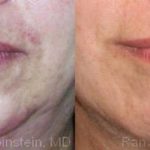 Botox Before and After Photos in Montvale, NJ, Patient 12291