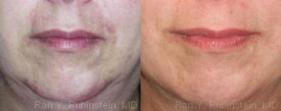 Botox Before and After Photos in Montvale, NJ, Patient 12291