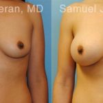 Breast Augmentation Before and After Photos in Montvale, NJ, Patient 12299