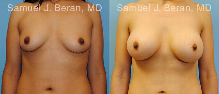 Breast Augmentation Before and After Photos in Montvale, NJ, Patient 12299