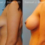 Breast Augmentation Before and After Photos in Montvale, NJ, Patient 12299