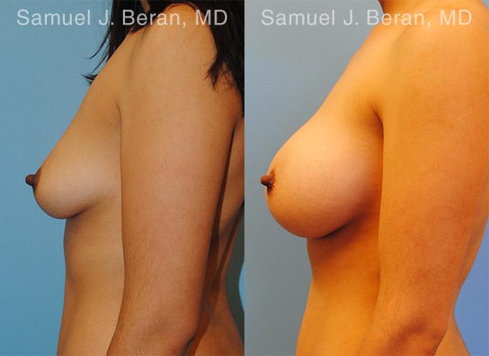 Breast Augmentation Before and After Photos in Montvale, NJ, Patient 12299