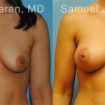 Breast Augmentation Before and After Photos in Montvale, NJ, Patient 12304