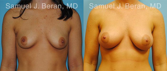 Breast Augmentation Before and After Photos in Montvale, NJ, Patient 12304