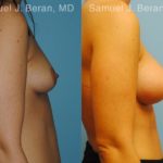 Breast Augmentation Before and After Photos in Montvale, NJ, Patient 12304