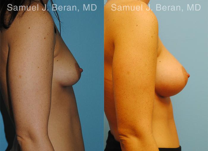 Breast Augmentation Before and After Photos in Montvale, NJ, Patient 12304