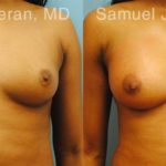 Breast Augmentation Before and After Photos in Montvale, NJ, Patient 12309