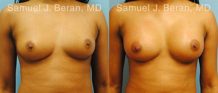 Breast Augmentation Before and After Photos in Montvale, NJ, Patient 12309