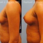 Breast Augmentation Before and After Photos in Montvale, NJ, Patient 12309