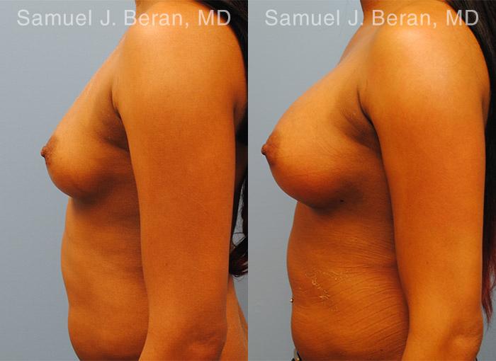 Breast Augmentation Before and After Photos in Montvale, NJ, Patient 12309