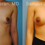 Breast Augmentation Before and After Photos in Montvale, NJ, Patient 12314