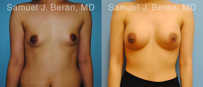 Breast Augmentation Before and After Photos in Montvale, NJ, Patient 12314