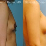 Breast Augmentation Before and After Photos in Montvale, NJ, Patient 12314