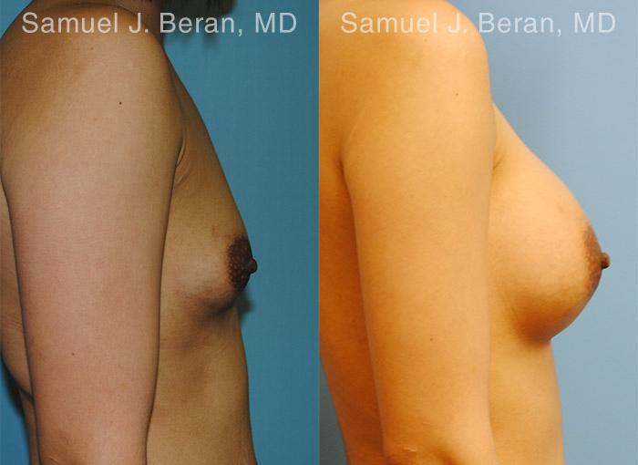 Breast Augmentation Before and After Photos in Montvale, NJ, Patient 12314