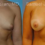 Breast Augmentation Before and After Photos in Montvale, NJ, Patient 12319