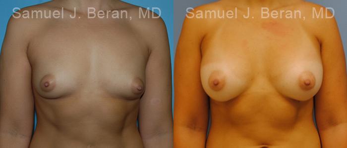 Breast Augmentation Before and After Photos in Montvale, NJ, Patient 12319