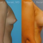 Breast Augmentation Before and After Photos in Montvale, NJ, Patient 12319