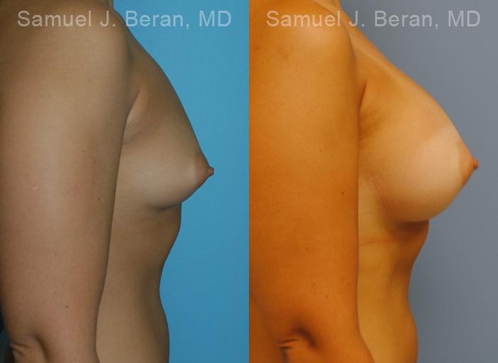 Breast Augmentation Before and After Photos in Montvale, NJ, Patient 12319