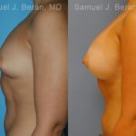 Breast Augmentation Before and After Photos in Montvale, NJ, Patient 12319