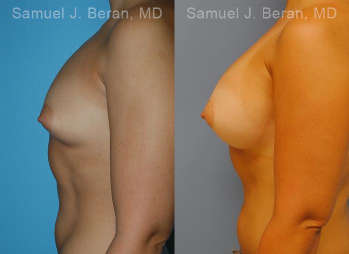 Breast Augmentation Before and After Photos in Montvale, NJ, Patient 12319