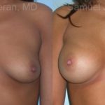 Breast Augmentation Before and After Photos in Montvale, NJ, Patient 12326