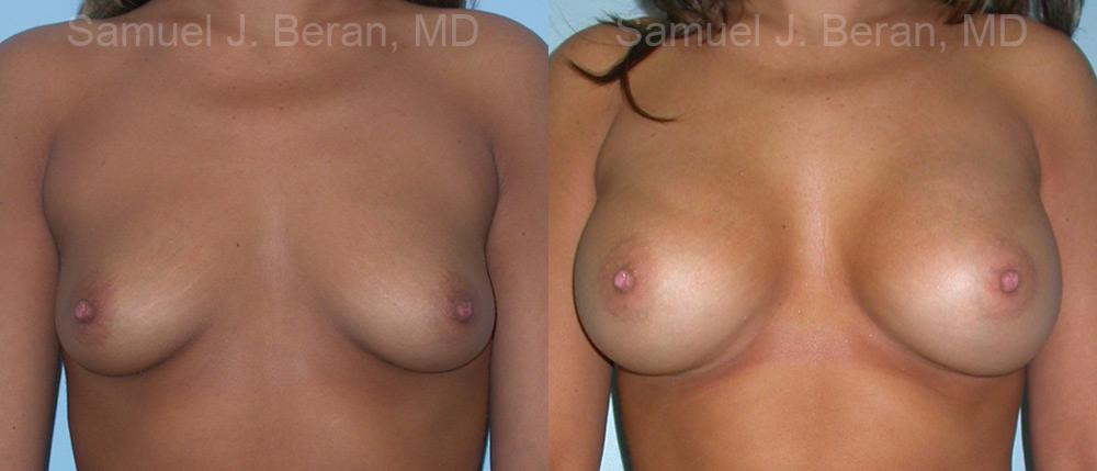 Breast Augmentation Before and After Photos in Montvale, NJ, Patient 12326