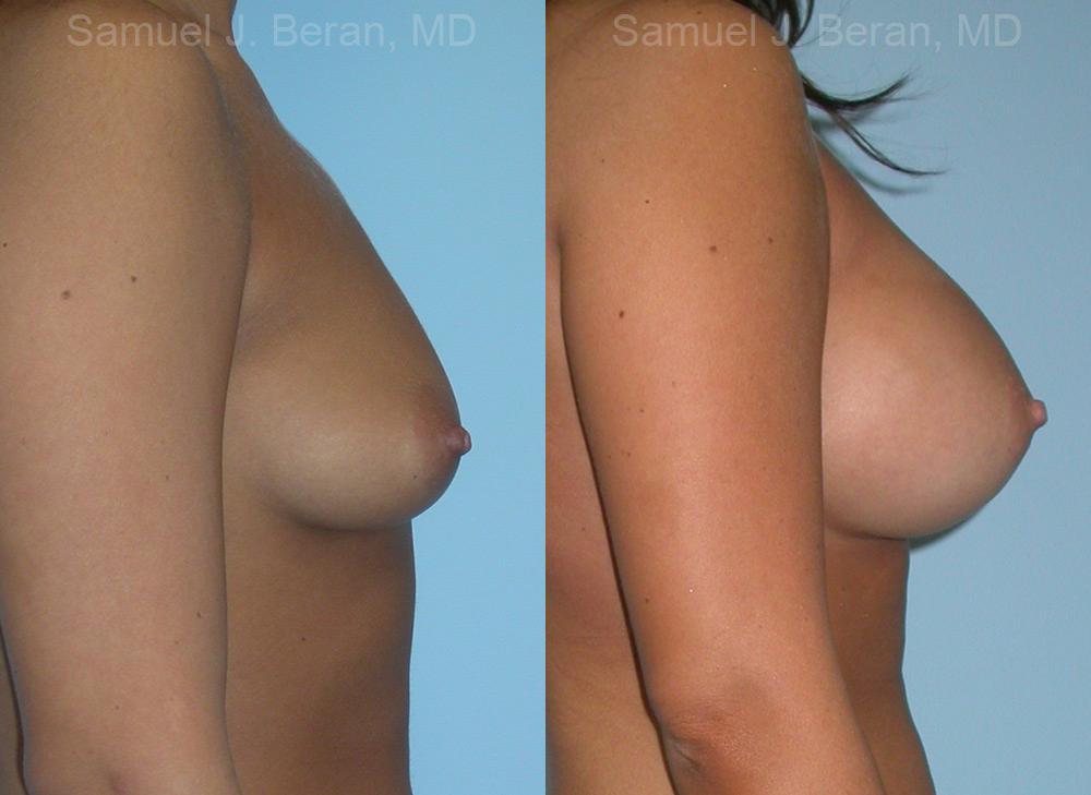 Breast Augmentation Before and After Photos in Montvale, NJ, Patient 12326