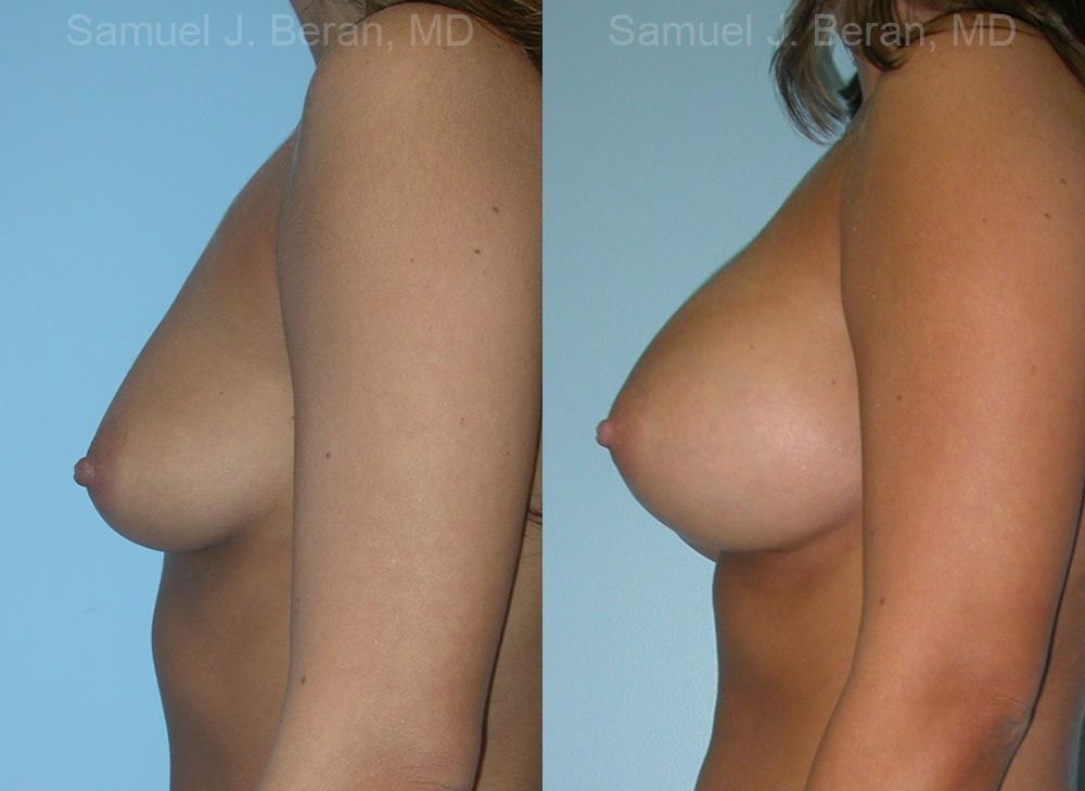 Breast Augmentation Before and After Photos in Montvale, NJ, Patient 12326