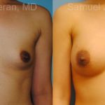 Breast Augmentation Before and After Photos in Montvale, NJ, Patient 12333