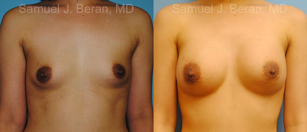 Breast Augmentation Before and After Photos in Montvale, NJ, Patient 12333